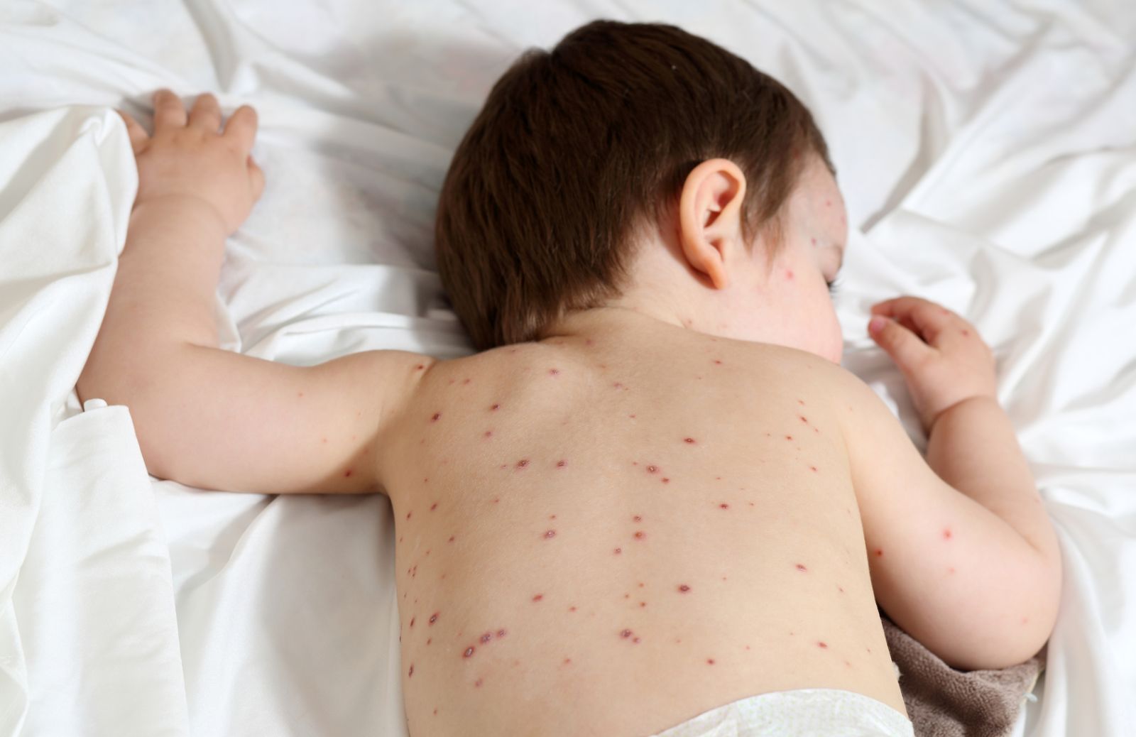 Varicella nei bambini: 5 segnali per riconoscerla