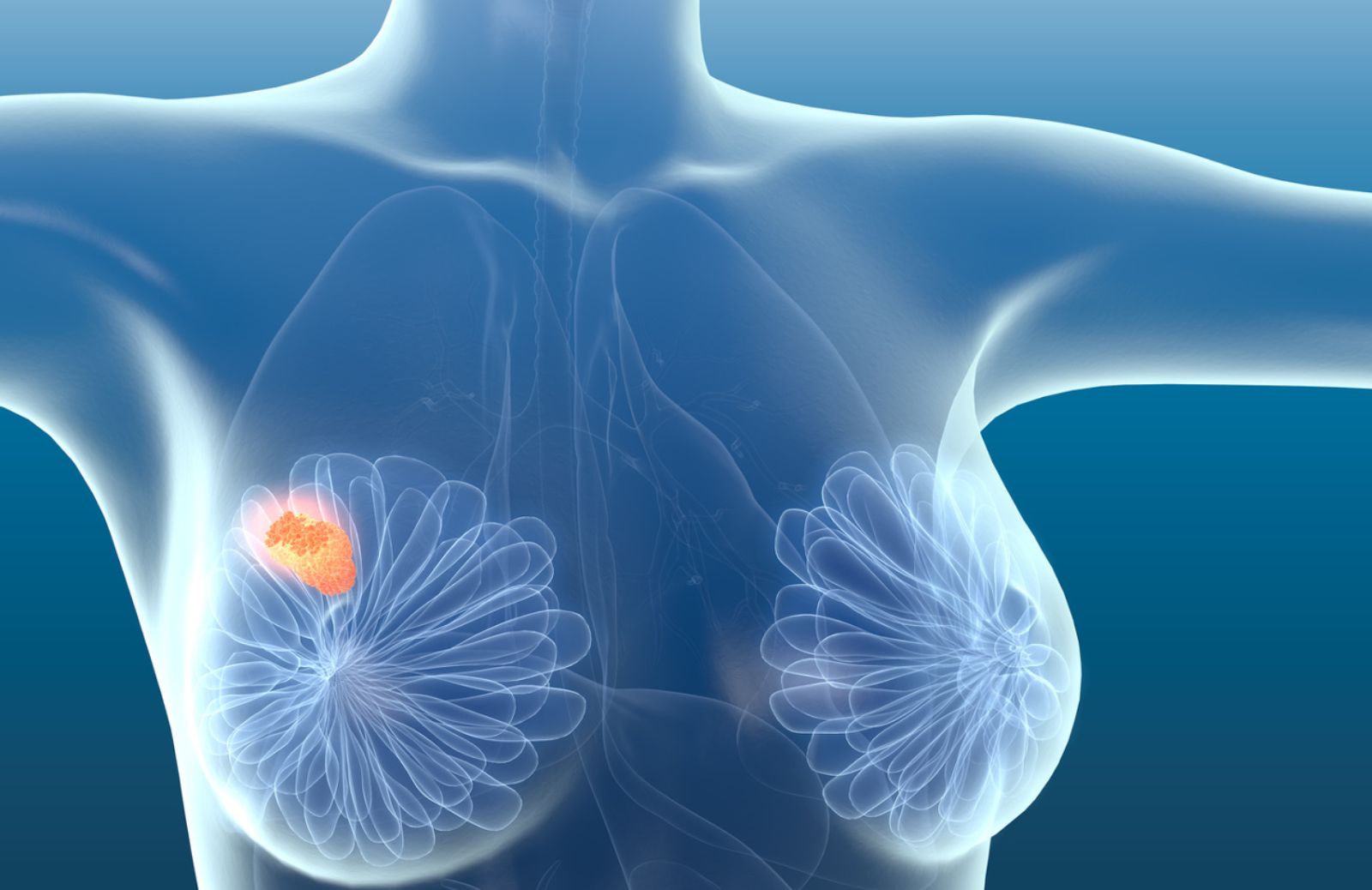 Come combattere il tumore al seno con la Dieta Mima Digiuno