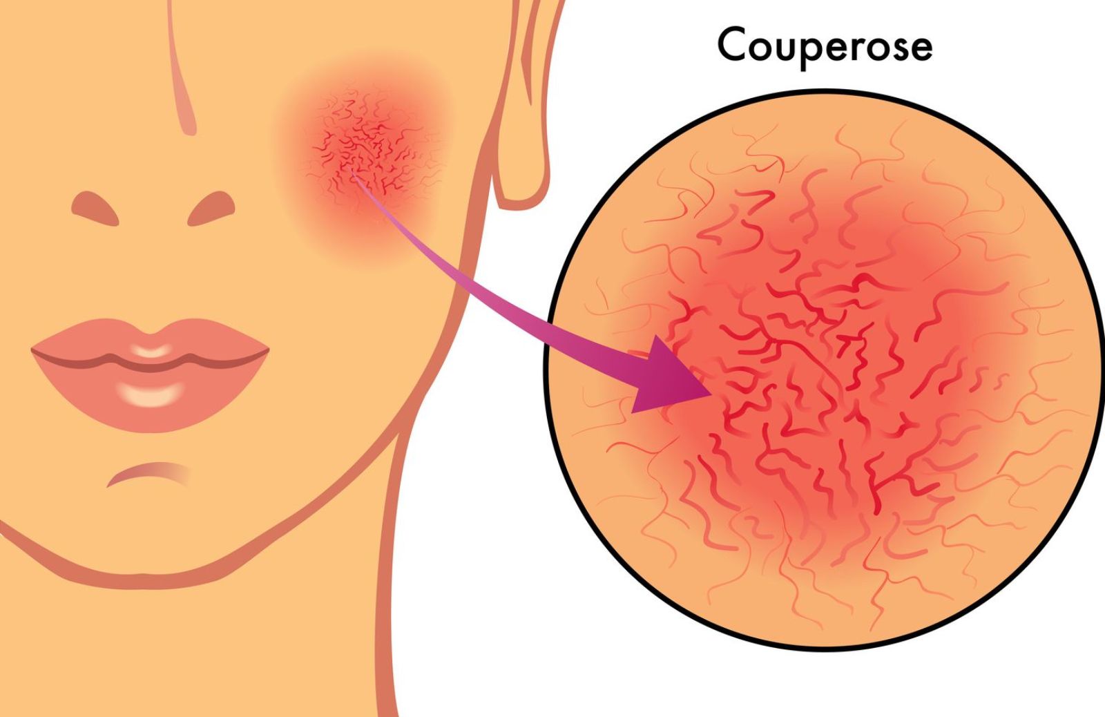 Couperose: tutto quello che c'è da sapere