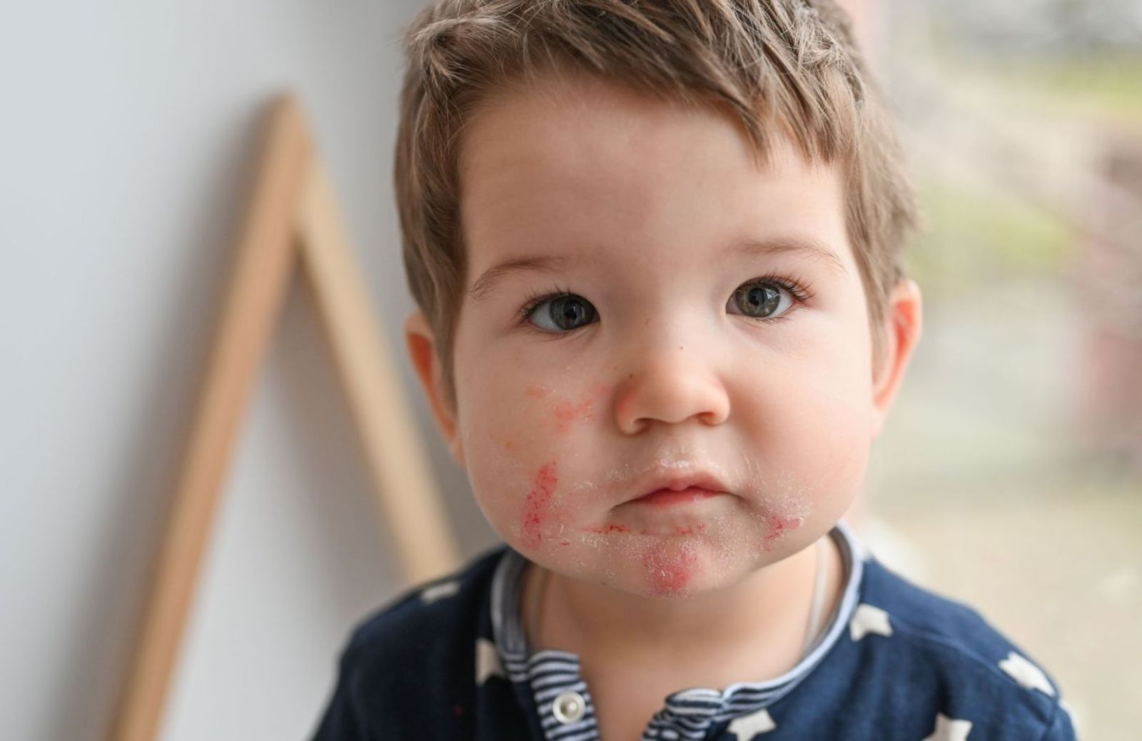 Dermatite periorale: come curare il rossore intorno alla bocca dei bambini