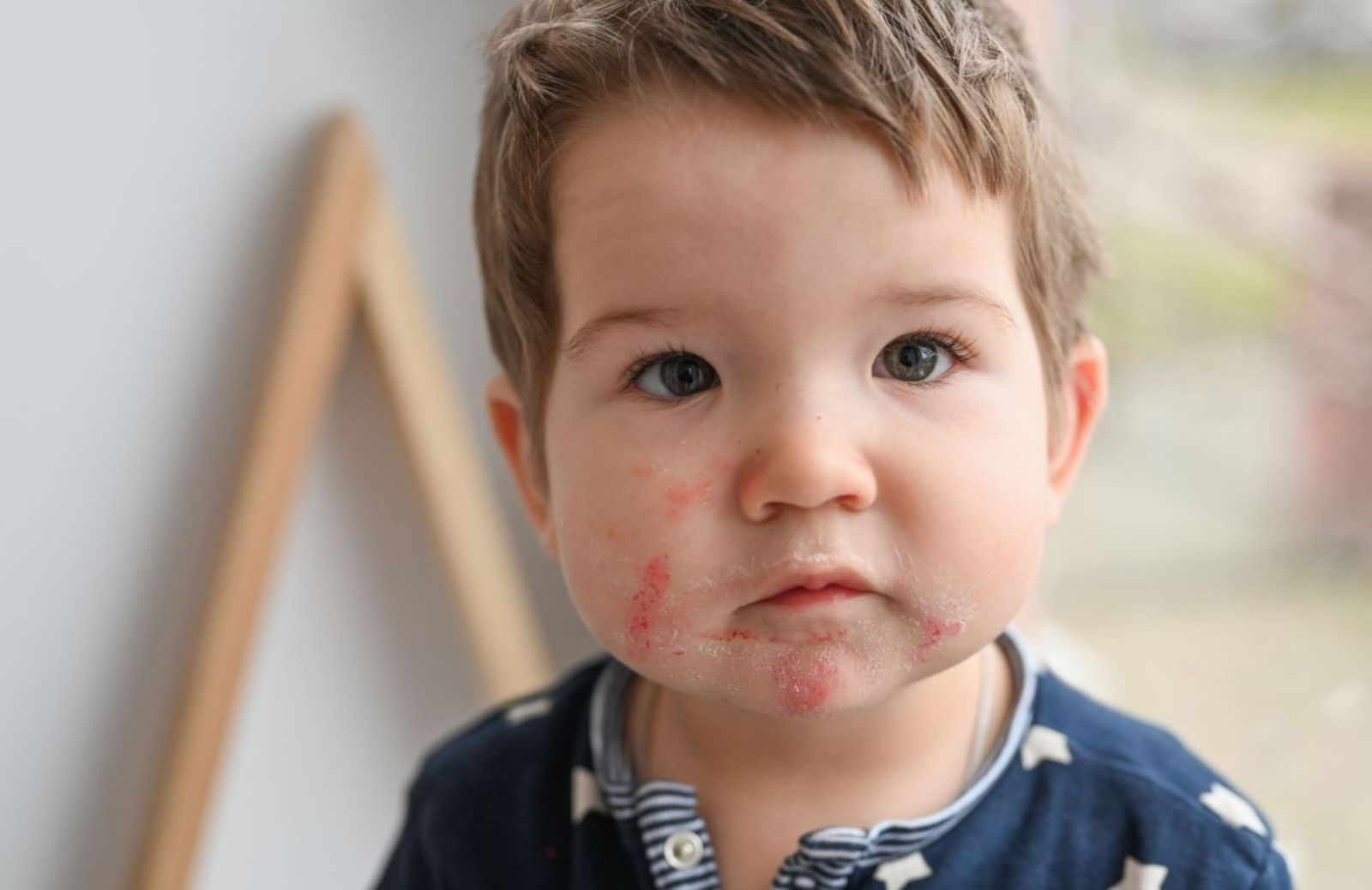 Dermatite periorale: cos'è e come si cura nei bambini