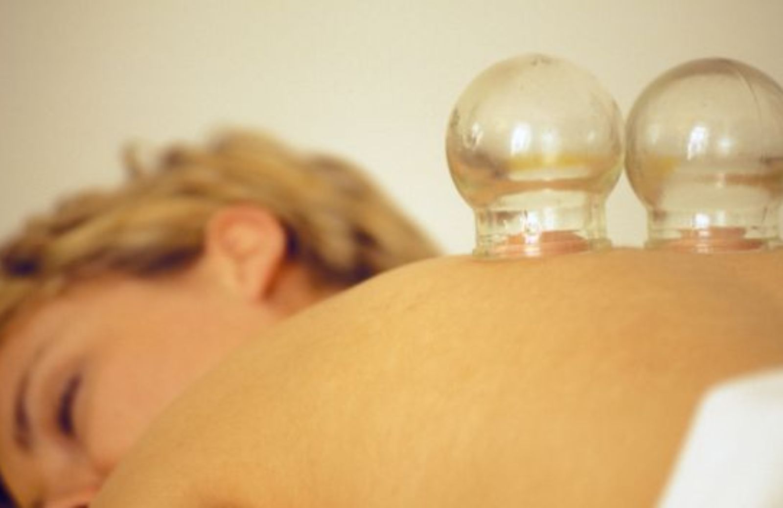 Come curarsi con i benefici della cupping therapy