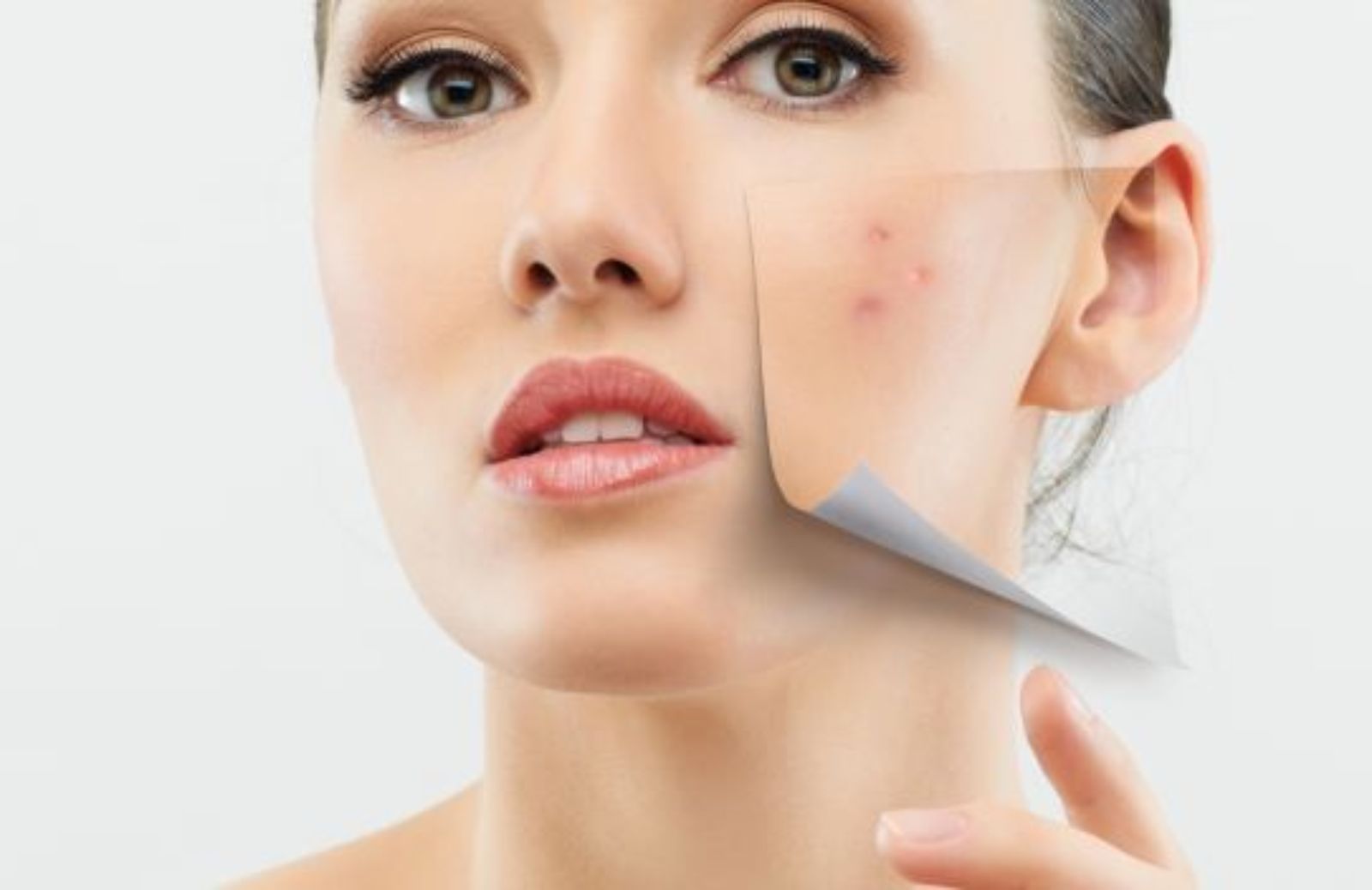 Come trattare le cicatrici da acne con i prodotti giusti