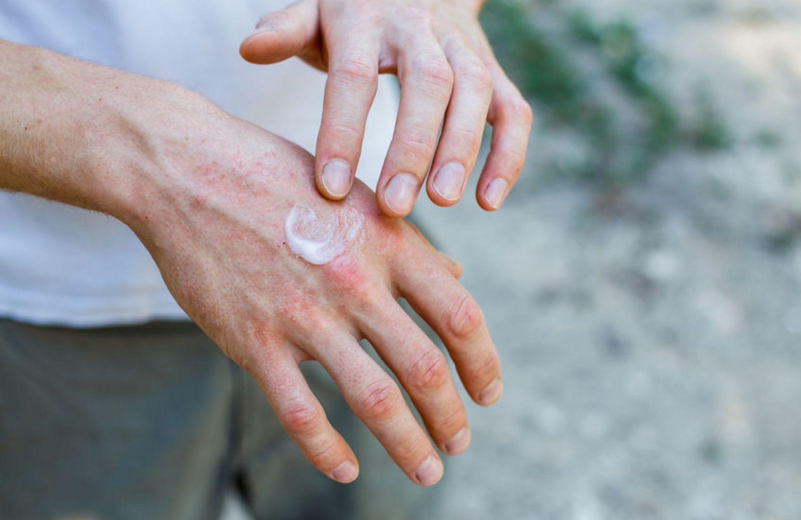Bolle sulle mani: cosa sono e come si curano