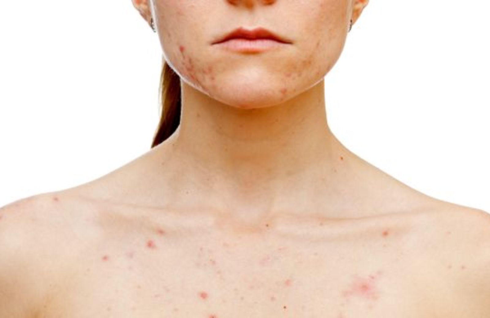 Come evitare che la varicella lasci segni sulla pelle