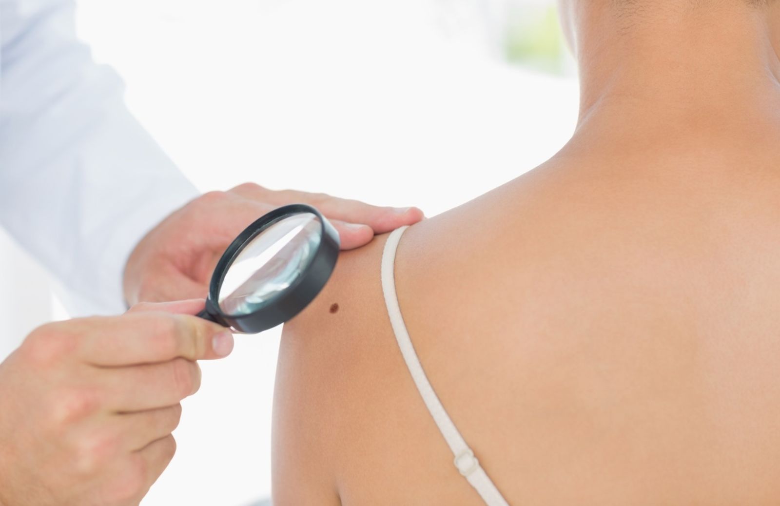 Come riconoscere un melanoma con il metodo ABCDE