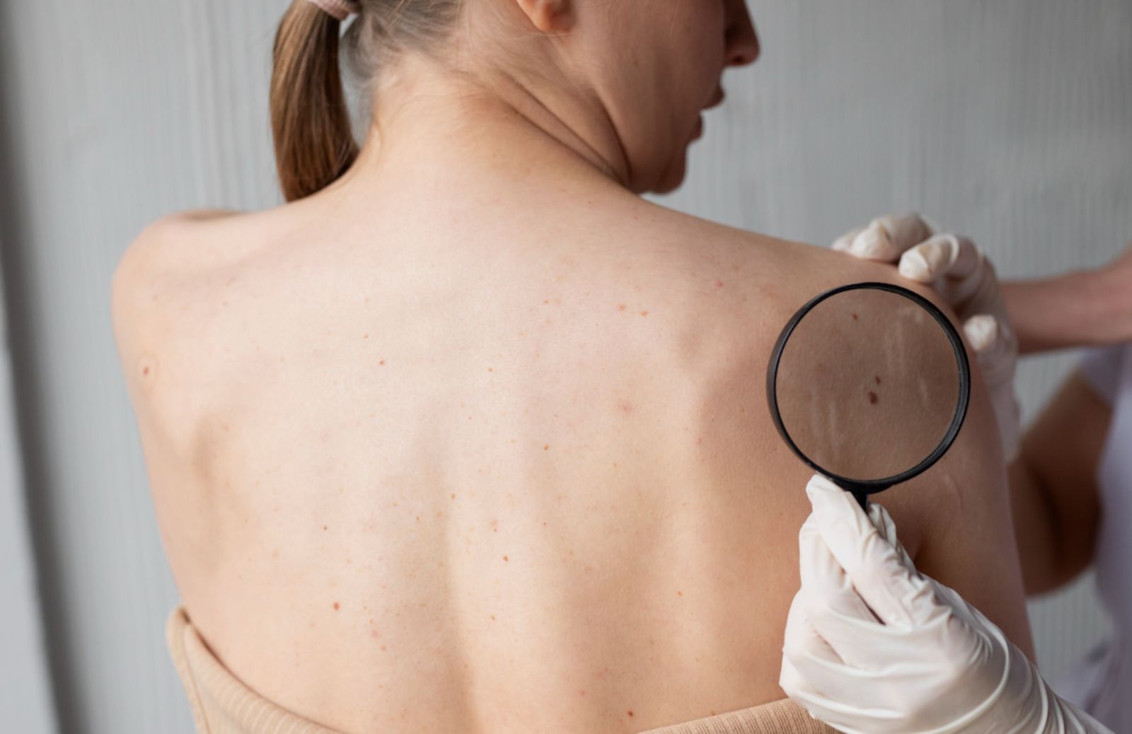 Melanoma: come proteggersi dal tumore alla pelle