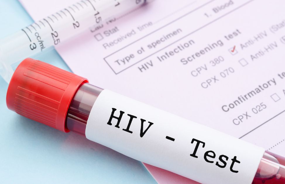 Test HIV perché, quando e come