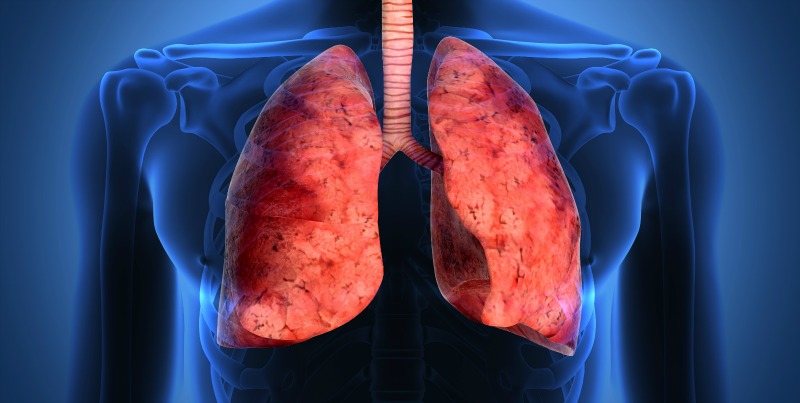 Come Curare La Fibrosi Polmonare Idiopatica Cause Sintomi E 