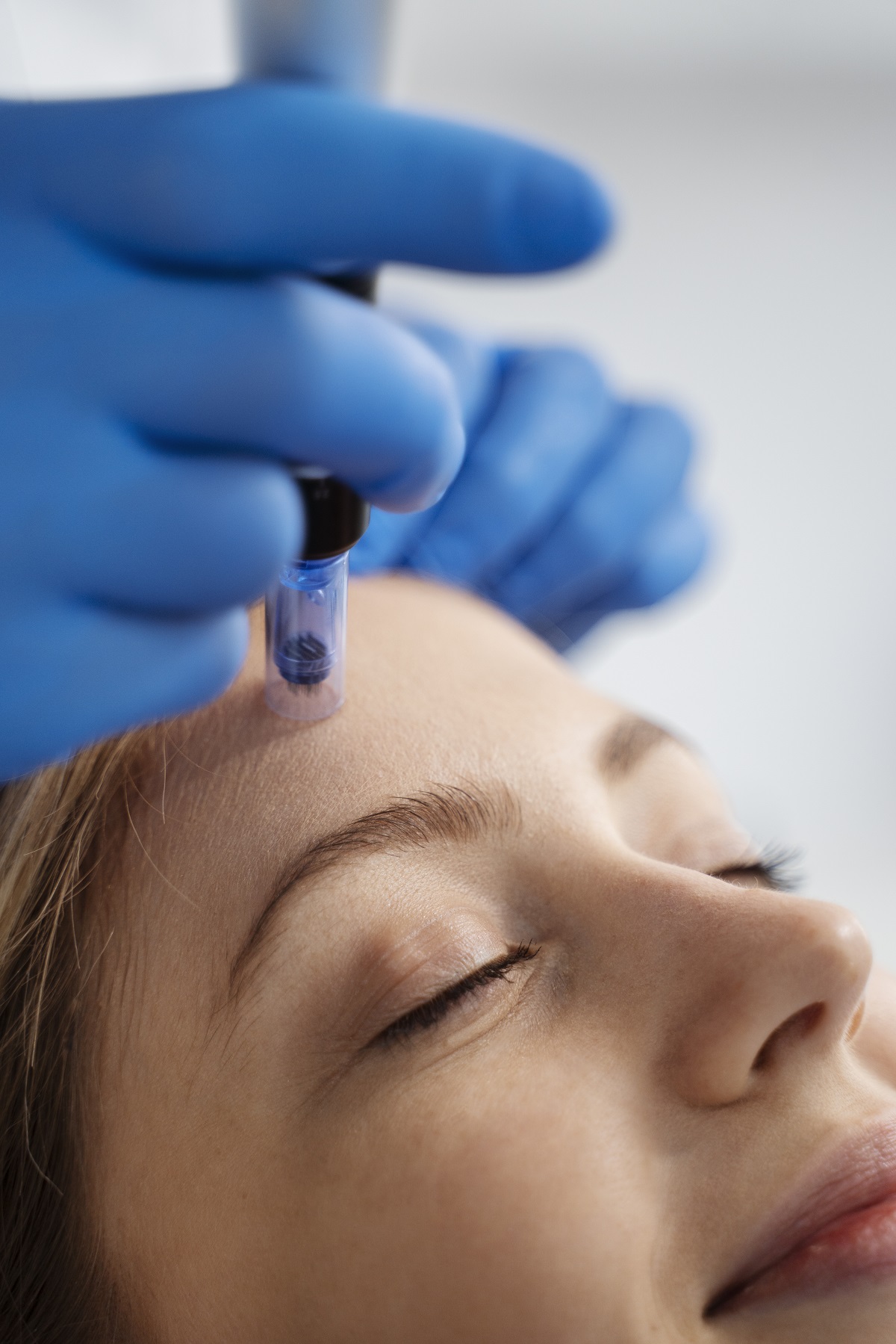 Microneedling viso