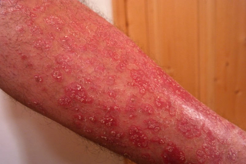 Dermatiti